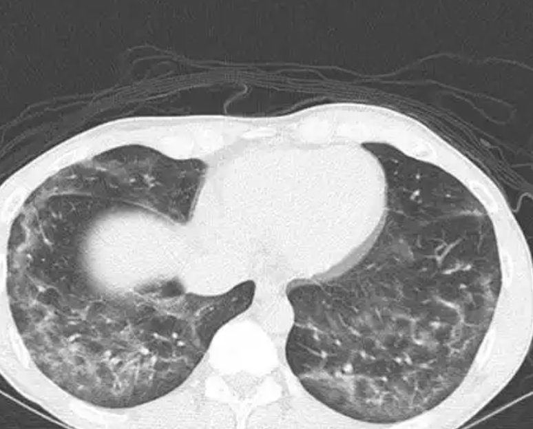 美国肺脏协会最新报告：近半数美国民众生活在